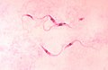 Chagas disease