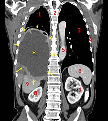 Tumor Mesothelioma2 legend.jpg