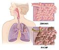 Thumbnail for Chronic obstructive pulmonary disease