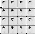 Normal hepatobiliary scan (HIDA scan). The nuclear medicine hepatobiliary scan is clinically useful in the detection of the gallbladder disease.