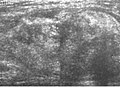 Fig. 5 Ultrasonography of a liposarcoma with high-echo areas reflected from its lipomatous matrix and low-echo areas reflected from its non-lipomatous areas.[69]