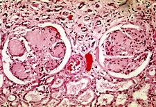 diabetická glomeruloskleróza