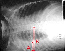 An X-ray showing a chest lying horizontal. Ang itim na na nasa ibabang bahagi na ang kanang baga ay mas maliit na may mas maputing bahagi sa ilalim nito dahil sa pag-ipon ng likido sa baga. Mayroong mga pulang arrow na sumusukat sa laki ng mga ito.