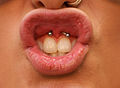 Lip frenulum (Smiley) piercing